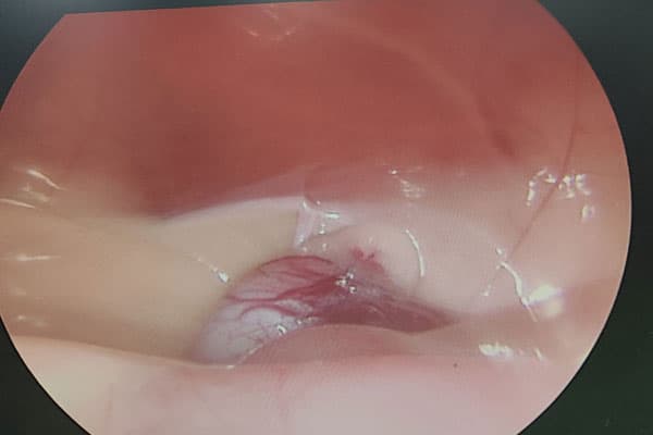 Cirugía de mínima invasión